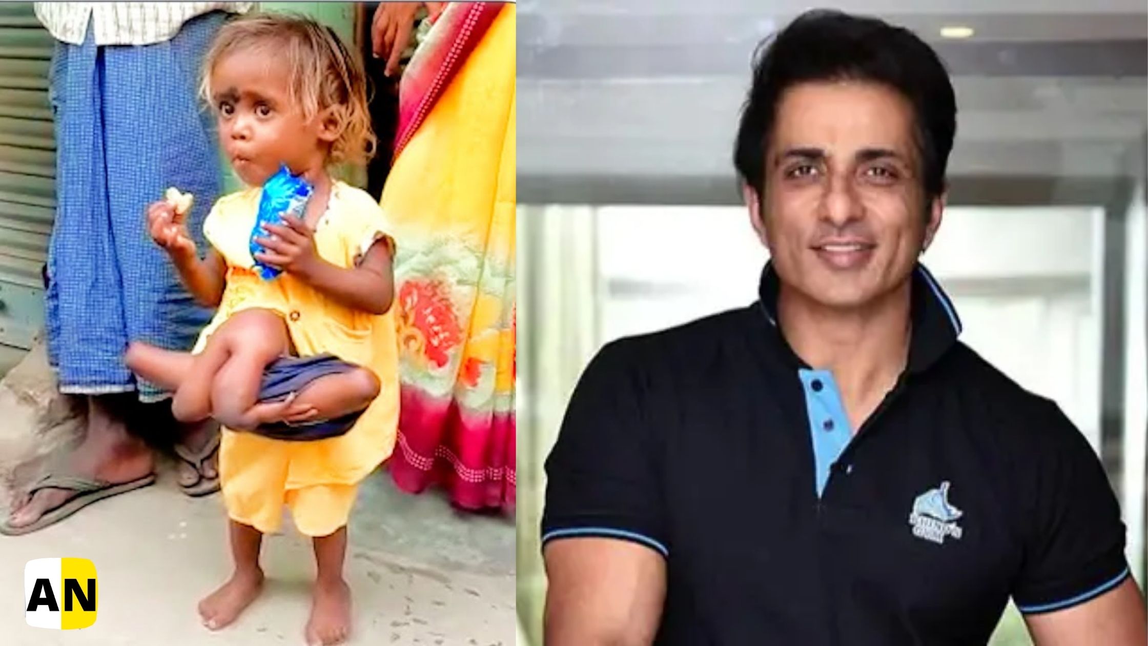 sonu sood helping a girl born with four arms and legs